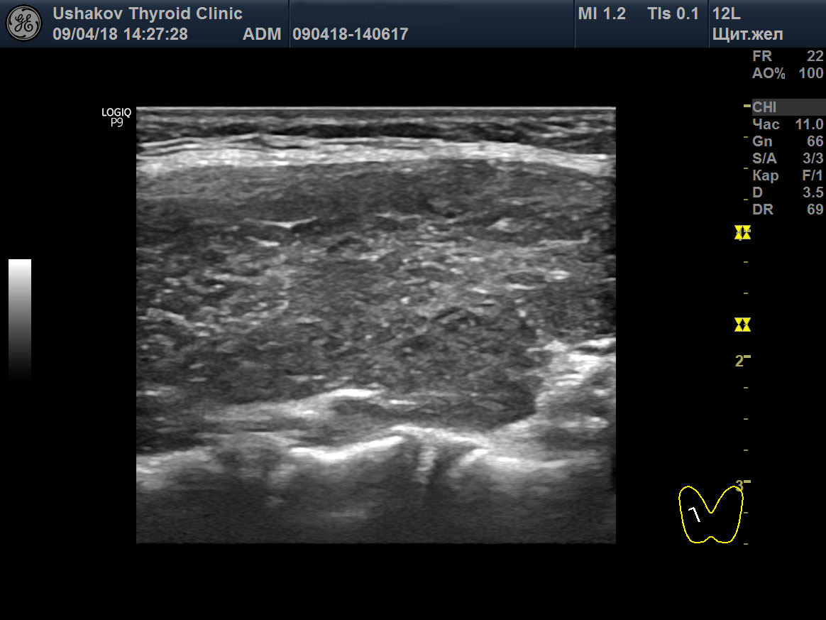Ультразвуковая диагностика диффузных процессов щитовидной железы