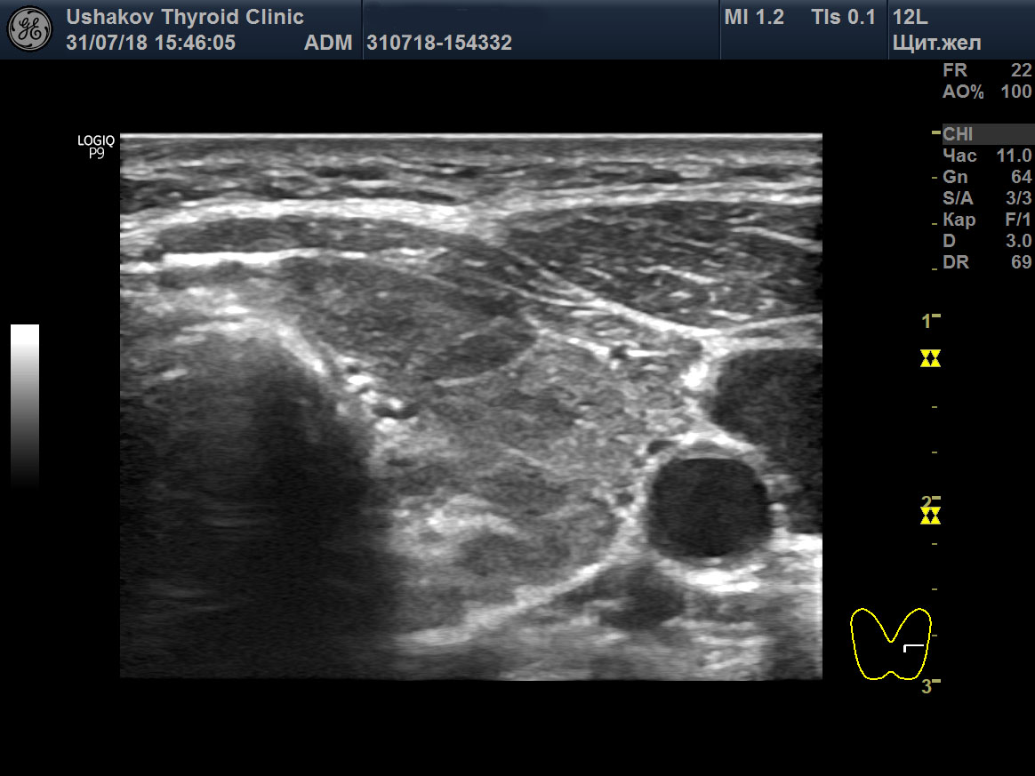 Ультразвуковая диагностика диффузных процессов щитовидной железы