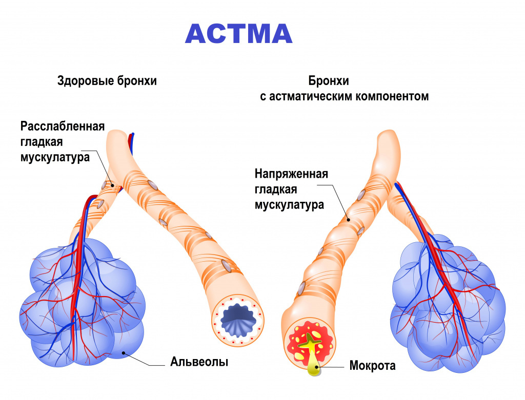 Астма