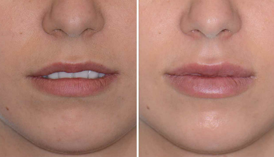 Juvederm Ultra XC до и после