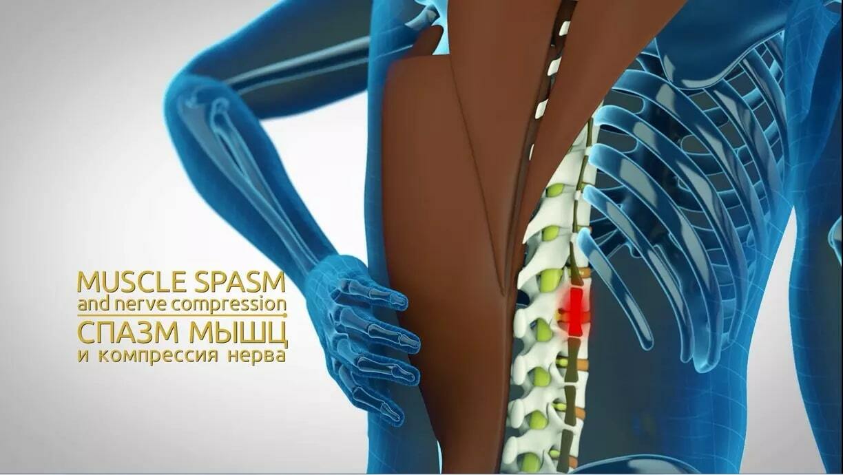 Спазм околопозвоночных мышц