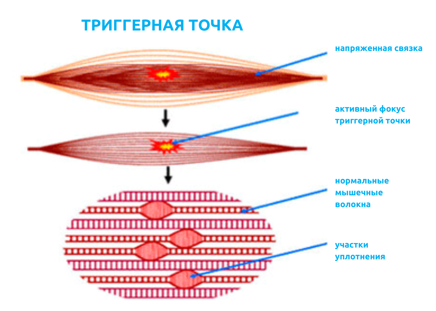 триггерные точки