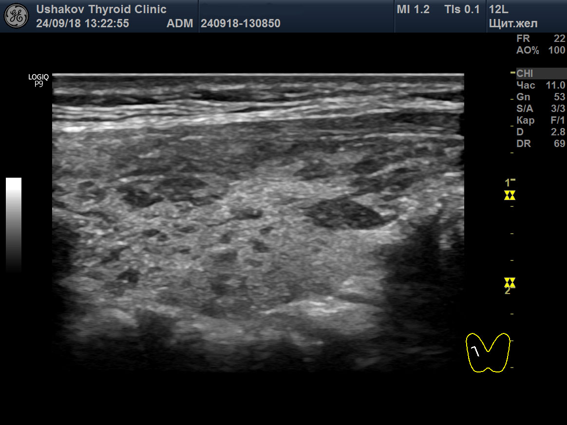 Ультразвуковая диагностика диффузных процессов щитовидной железы
