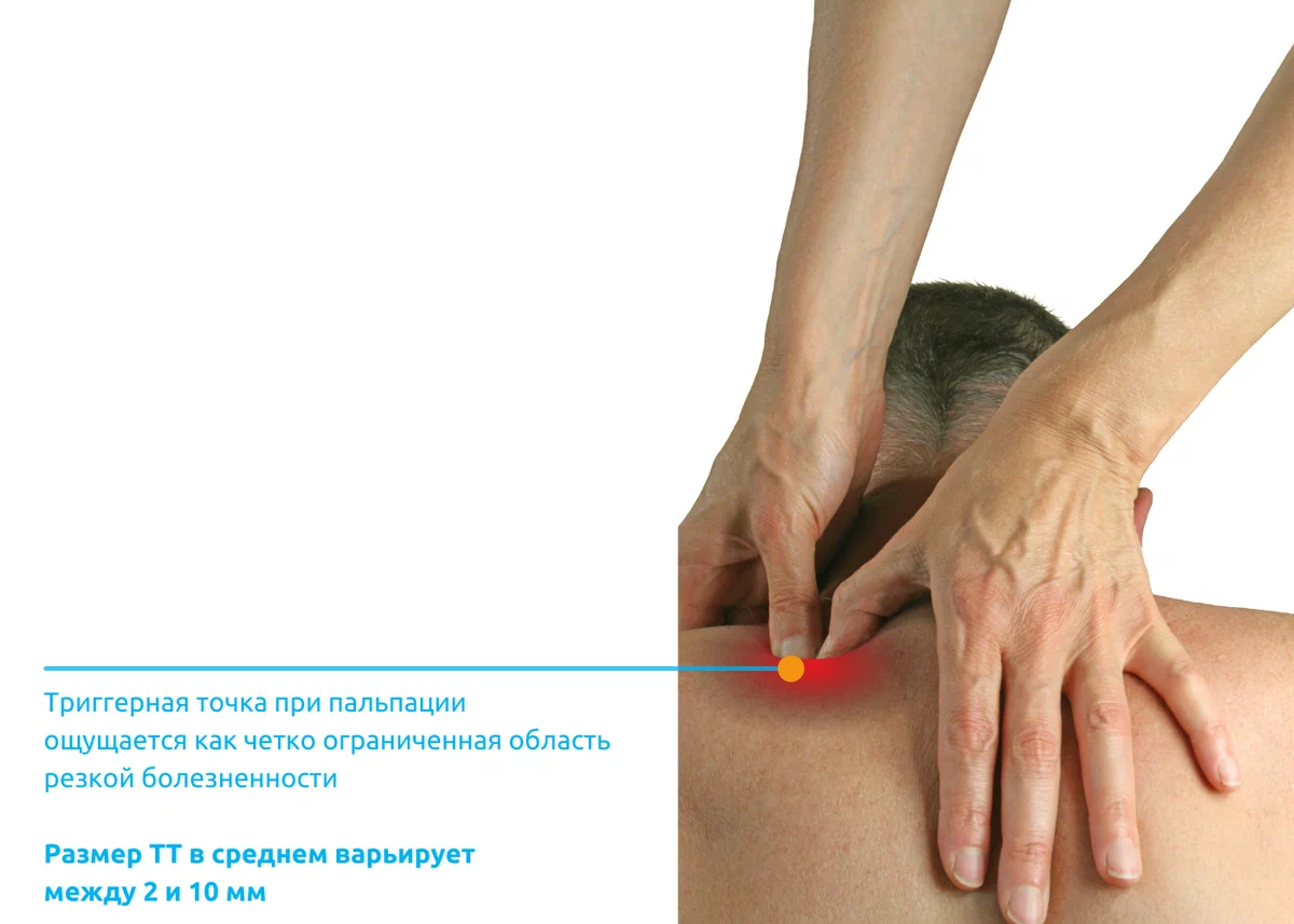 триггерные точки