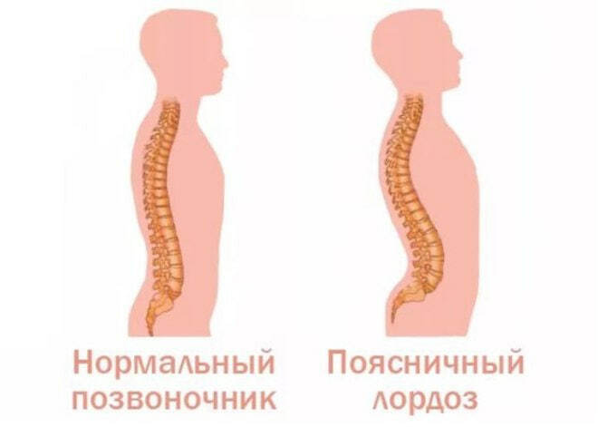 Сравнение нормального позвоночника и лордоза