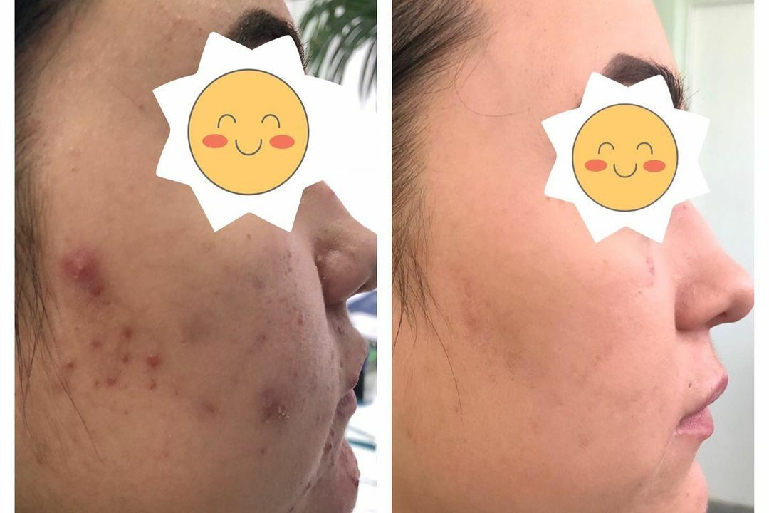 Угревая болезнь