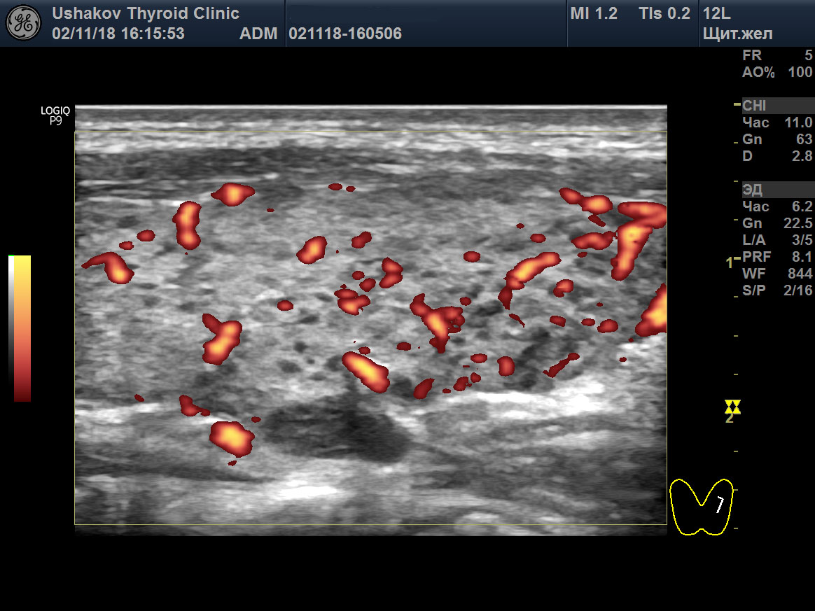 Ультразвуковая диагностика диффузных процессов щитовидной железы